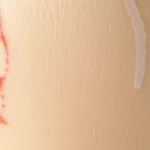 Close-up of skin texture showing stretch marks in various stages of healing, red inflammatory phase transitioning to white mature scars, clinical dermatology photography, natural lighting, photorealistic detail