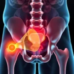 Medical illustration showing cross-section of proton beam trajectory through human pelvis with Bragg peak highlighted at prostate tumor location, surrounded by anatomical structures like bladder and rectum, clinical setting, photorealistic medical visualization