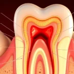 Close-up cross-section diagram of a tooth showing inflamed pulp tissue and root canal anatomy, photorealistic medical illustration with warm lighting, no text labels